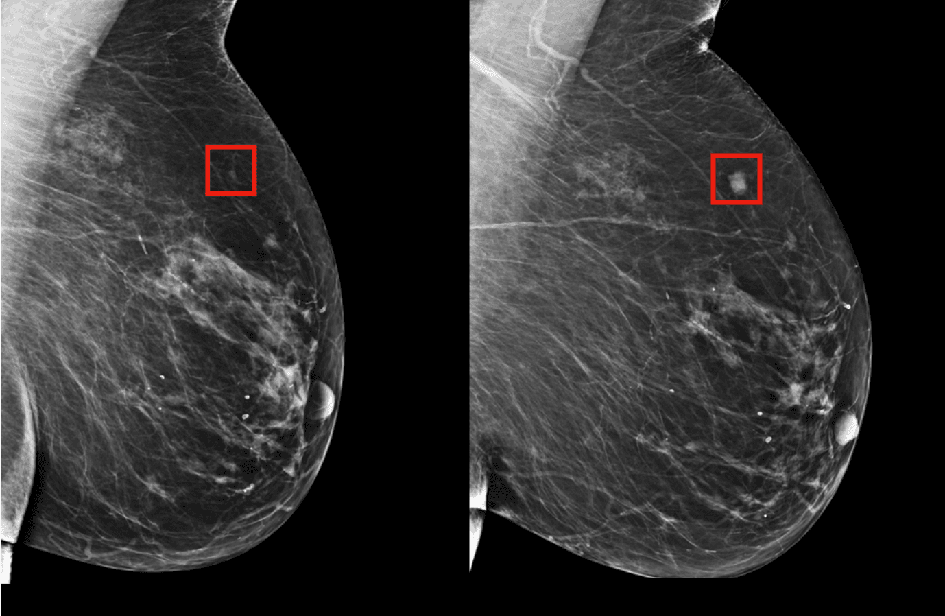 Mammogram case